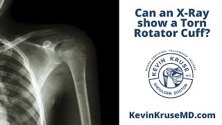 Can an XRay show a Torn Rotator Cuff [upl. by Suhcnip]