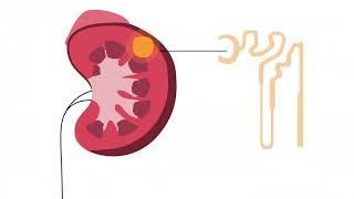 What is Chromophobe Renal Cell Carcinoma [upl. by Dedric]