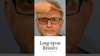 Hair transplant in India before and after results video [upl. by Atiekal]