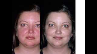 Adult Rosacea Before amp After Treatment [upl. by Sorensen589]