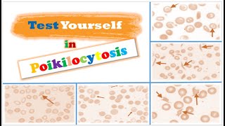 Review 📝  RBCs Morphological Abnormalities Poikilocytosis [upl. by Jolanta347]