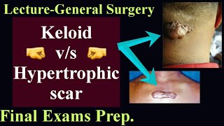 Scar and Keloid Management Hypertrophic and Keloid scars Treatment General SURGERY [upl. by Glick]