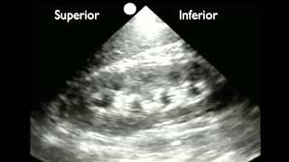 How to Renal Ultrasound  Hydronephrosis [upl. by Ynez75]