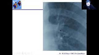 14 Etape de description reconnaître les structures normales du thorax [upl. by Berny]