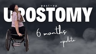 6 Months PostOp Urostomy Do I regret it [upl. by Rubina]