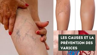 Comment prévenir et traiter les varices et les varicosités [upl. by Kerr]