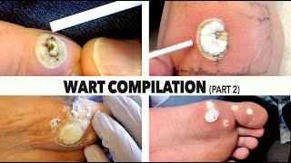 WART BURNING COMPILATION Part 2  Dr Paul [upl. by Kiefer]