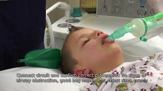 Paediatric Anaesthetics Chapter 2  LMA insertion 1 [upl. by Artcele]