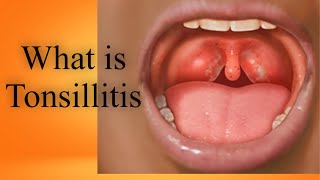 What is Tonsillitis Tonsils Kia hain Bachun me tonsils ka ilaj in UrduHindi [upl. by Deedahs]