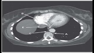 Chest amp Cardiac Anatomy 7Radiology anatomy with answers frcrradiopediamrictxrayquestionstip [upl. by Nnaitsirk]