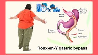 Roux en Y gastric bypass [upl. by Airret868]