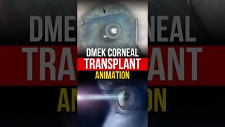 DMEK Corneal Transplant Surgery  Detailed Animated Procedure [upl. by Debbee403]