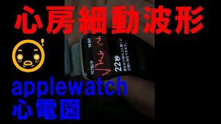 アップルウォッチ心電図で見た不整脈（心房細動）波形 applewatch atrial fibrillation [upl. by Aubree]