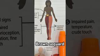 Brown sequard syndrome medicalstudent neetpg usmle [upl. by Ahsieyn269]