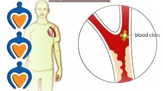 Thrombosis  What is it and how is it treated [upl. by Irtimd]