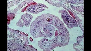 Schistosomiasis  Pathology mini tutorial [upl. by Lacie]