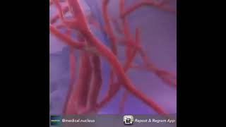 AVC Acidente Vascular Cerebral isquêmico [upl. by Laurice]