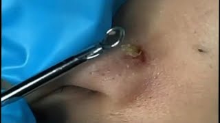 Big Cystic Acne Blackheads Extraction  Blackheads amp Milia  Whiteheads amp Comdones  Pimple Popping [upl. by Asylem]