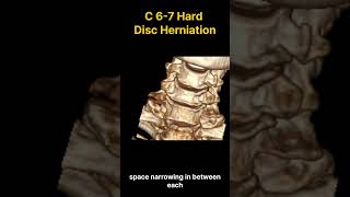 Cervical Disc Herniation Conquer C 67 Hard Disc Pain [upl. by Campos]