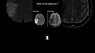 Diffusion weighted imaging – Infarct brain Quiz 19 radiologychannel007 [upl. by Gabriellia]