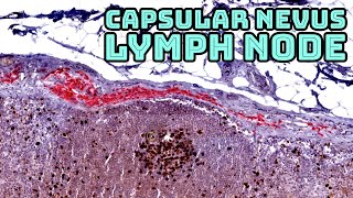 Benign Nevus in a Sentinel Lymph Node Capsular nevus with Ki67MART1 immunostain pathology [upl. by Callas]