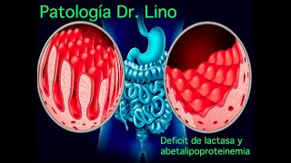 Anatomía patológica  Síndrome de Malabsorción  Deficiencia de lactasa y abetalipoproteinemia [upl. by Kemppe]