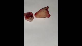 Wisdom extraction umairtoothfairy dentalsmile umairazeem viral shorts Umairazeem8553 [upl. by Siddon206]