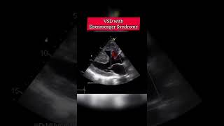 VSD with Eisenmenger Syndrome echocardiography echocardiogram echo shorts [upl. by Josi]