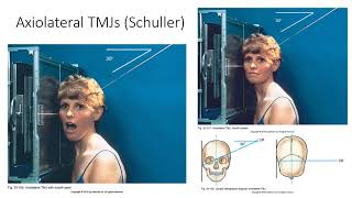 Radiographic Positioning of the TMJs [upl. by Wicks]