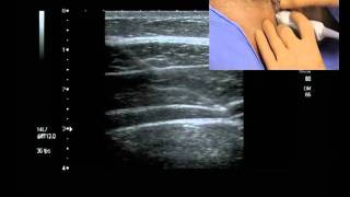 UltrasoundGuided Transversus Abdominis Plane Block [upl. by Valerio927]