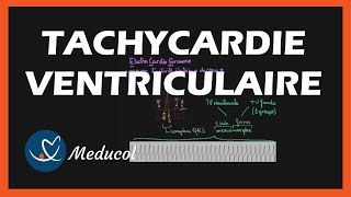 Tachycardie Ventriculaire ECG symptômes et traitement [upl. by Valaria762]