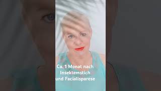 Rückbildung der Facialisparese nach ca 1 Monat naturheilkundlicher Behandlung [upl. by Ailahs]