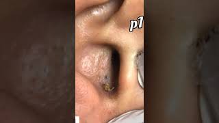 Blackheads Removal From The Ear [upl. by Nolrev]