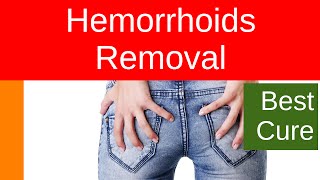 Hemorrhoids Removal [upl. by Janyte795]