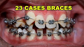 23 Case Braces Transformation [upl. by Latham61]