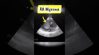 Parasternal short Axis View showing RA myxoma on Echocardiography heart tumor [upl. by Shum45]