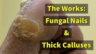 The Works Fungal Nails amp Thick Calluses 4K [upl. by Ibor486]