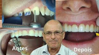 Dentes gastos por refluxo corrigidos com restaurações em porcelanas  Dr Antônio Sérgio F Freitas [upl. by Osnola]