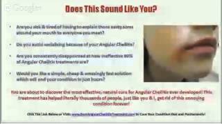 Antifungal Cream for Angular Cheilitis  Angular Cheilitis Treatment [upl. by Nonregla]