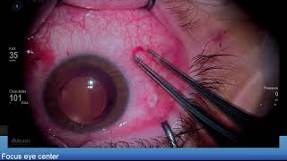 Retinal detachment due to retinoschisis Lukan Mishev Live Stream [upl. by Loren267]