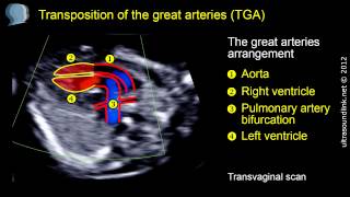 Transposition of the great arteries TGA [upl. by Jeni]