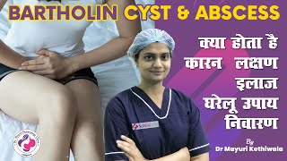 Bartholin Cyst amp Abscess in Hindi  बार्थोलिन सिस्ट क्या होता है कारण लक्षण इलाज और घरेलू उपाय [upl. by Aitrop]