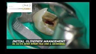 endodontic treatment upper premolar continuous wave obturation one curve micromega ultrax eighteeth [upl. by Nnaira]