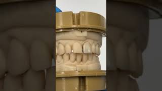 Central Monet Pure Zirconia Crown EnvisiontecMain envisiontec lsk121shorts dentistteeth [upl. by Nnaoj]