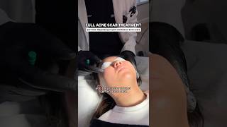 FULL Acne Scar Treatment for Ice Pick  Boxcar Scars with Dr Qazi  Part One Diagnosing the Scars [upl. by Potts]