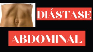 Exercícios para Diástase Abdominal [upl. by Ottavia]