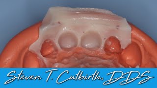 Temporary Veneer Fabrication  Dental Minute with Steven T Cutbirth DDS [upl. by Coppola]