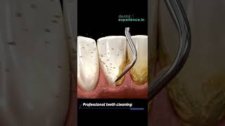 Tooth Cleaning  Teeth Scaling I stain or Tartar Removal cost  Dentalexperiencein [upl. by Marasco]