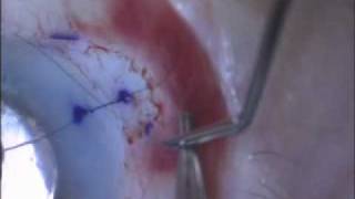 Placing your first corneal suture during cataract surgery [upl. by Nomrej853]