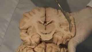 Cortical Localization Neuroanatomy Video Lab  Brain Dissections [upl. by Ernest]